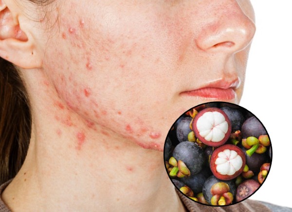 Ăn măng cụt có nổi mụn không? Cách ăn đúng để da khỏe đẹp