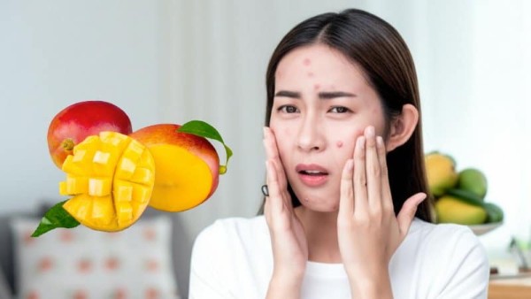 Ăn xoài có nổi mụn không? Cách ăn đúng để không lo nổi mụn
