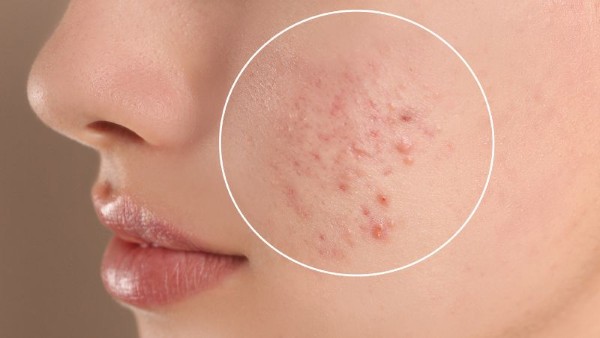 Break out mụn là gì? Cách nhận biết tình trạng da đang break out