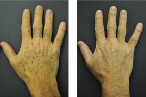 Đồi mồi ở tay: Nguyên nhân, cách điều trị và phòng ngừa Đồi mồi ở tay: Nguyên nhân, cách điều trị và phòng ngừa