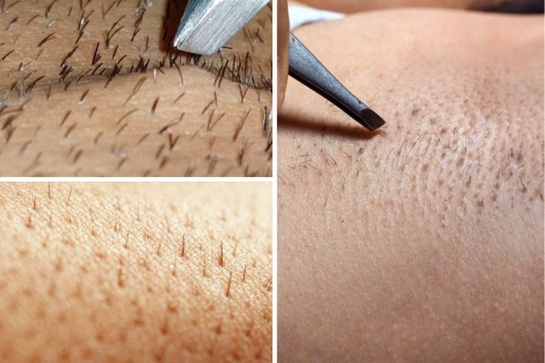 Tình trạng lông nách mọc đôi là gì?