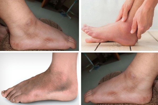 Mắt cá chân bị chai là gì?