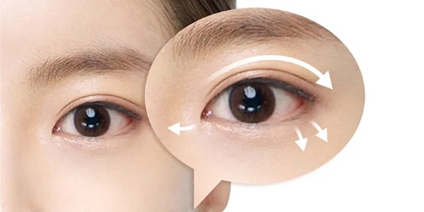 Cắt mí mắt – Giải pháp tối ưu và lâu dài