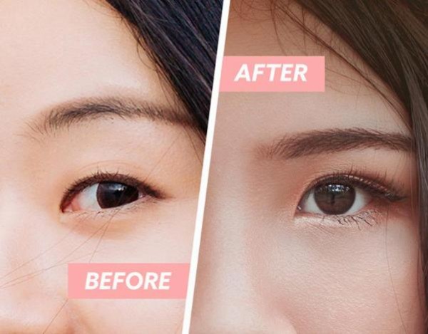 Mí lót có nên cắt mí không?