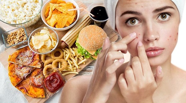 Chế độ ăn uống không lành mạnh làm tăng nguy cơ nổi mụn ở cổ Chế độ ăn uống không lành mạnh làm tăng nguy cơ nổi mụn ở cổ