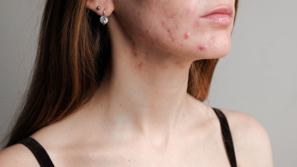 Mụn ở dưới cổ có thể tự biến mất không? Mụn ở dưới cổ có thể tự biến mất không?