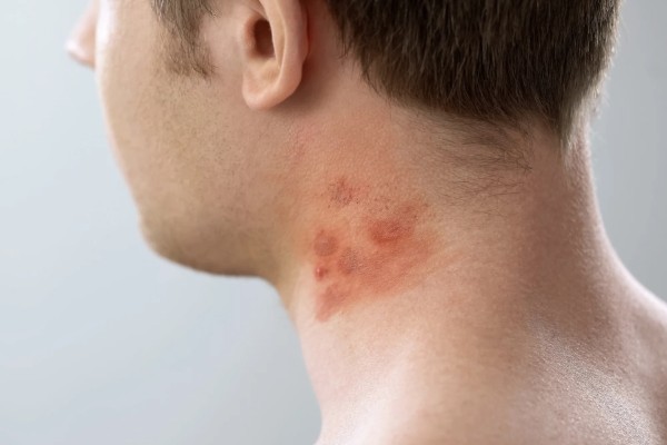 Mụn ở dưới cổ có phải là dấu hiệu nguy hiểm? Mụn ở dưới cổ có phải là dấu hiệu nguy hiểm?