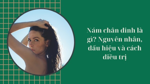 Nám chân đinh là gì? Nguyên nhân, dấu hiệu và cách điều trị