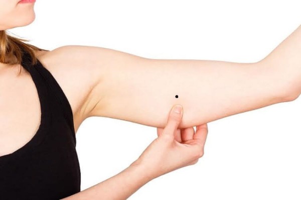 Tìm hiểu về nốt ruồi ở bắp tay