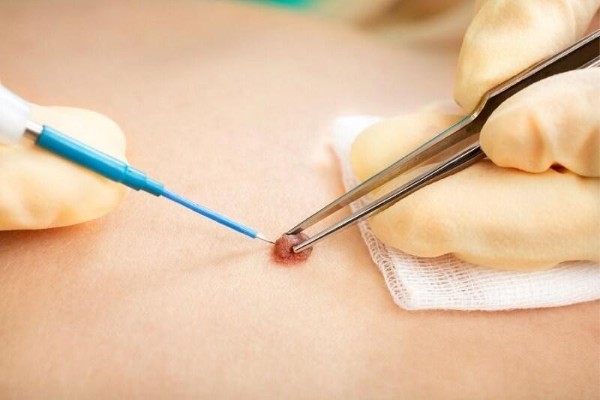 Phẫu thuật cắt bỏ nốt ruồi ở bắp tay