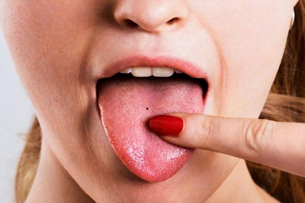 Ý nghĩa nốt ruồi ở giữa lưỡi