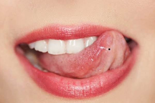 Việc phát hiện sớm nốt ruồi ác tính sẽ nâng cao khả năng điều trị thành công