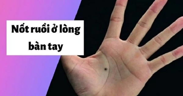 Nốt ruồi trong lòng bàn tay trái ở nữ