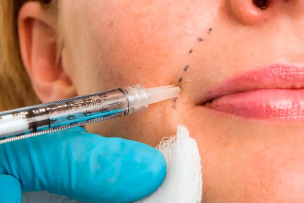 Tiêm filler HA là một giải pháp xóa bỏ các nếp nhăn sâu từ khóe mũi đến khóe miệng, giúp bạn có được khuôn mặt trẻ trung
