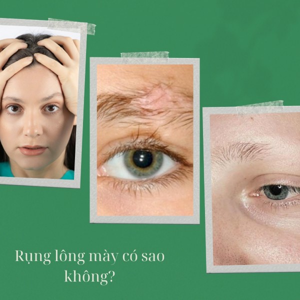 Rụng lông mày là bệnh gì? Rụng lông mày có sao không?