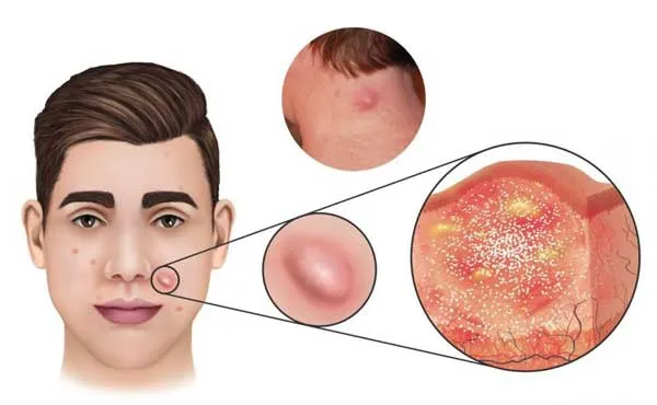 Tác hại của miếng dán mụn: Nguy cơ tiềm ẩn bạn nên biết