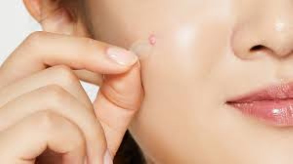 Tìm hiểu miếng dán trị mụn là gì?