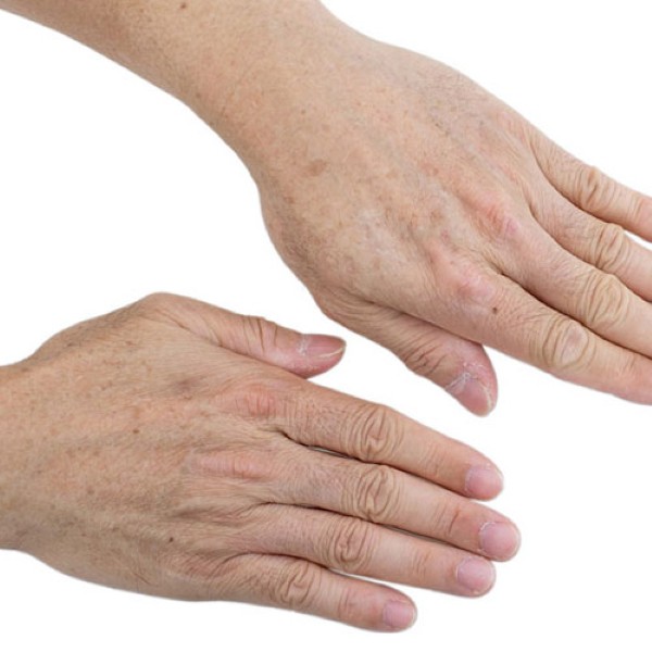 Tàn nhang ở tay do căng thẳng và tuổi tác Tàn nhang ở tay do căng thẳng và tuổi tác