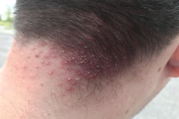 Viêm nang lông da đầu có chữa được không?