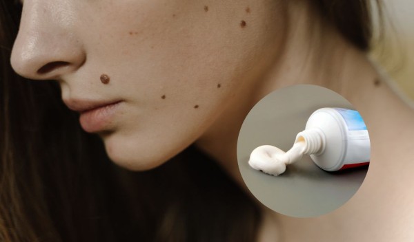Cách tẩy nốt ruồi tại nhà bằng kem đánh răng an toàn, hiệu quả