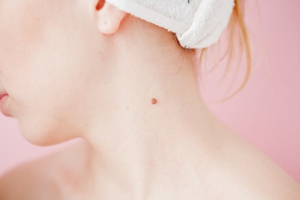 Nốt ruồi ở cổ là tốt hay xấu?