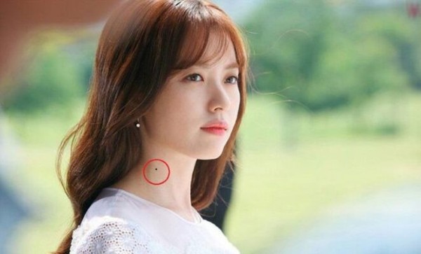 Nốt ruồi ở cổ bên trái