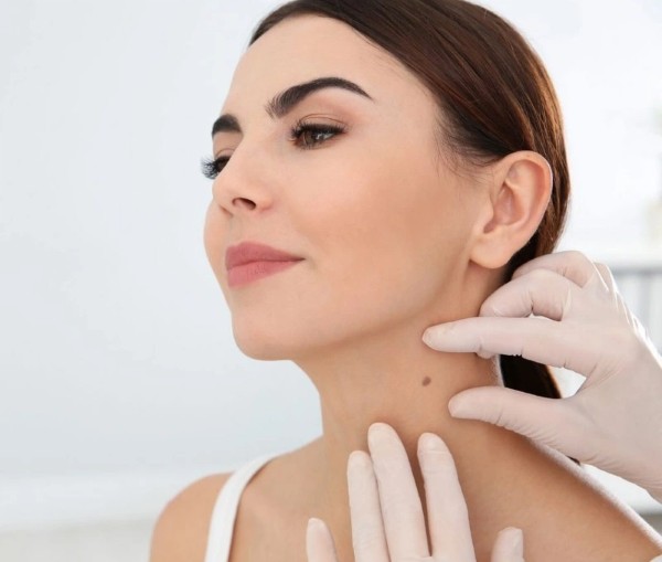 Khi nào nên tẩy nốt ruồi ở cổ?