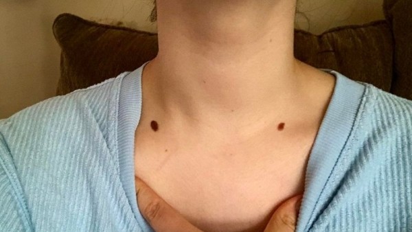 Trường hợp nên tẩy nốt ruồi ở xương quai xanh