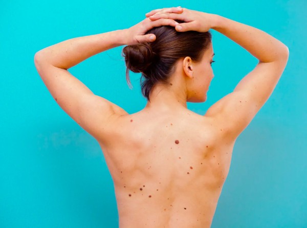 Nốt ruồi sau lưng phụ nữ báo hiệu điều gì – Tốt hay xấu?