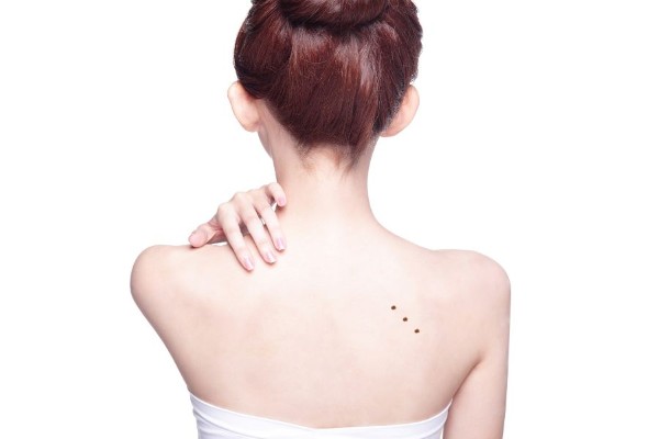 Ba nốt ruồi mọc thẳng hàng trên lưng