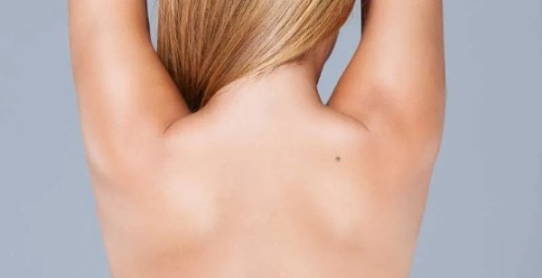 Trường hợp không cần tẩy nốt ruồi