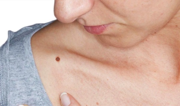 Nốt ruồi lồi có tẩy được không?