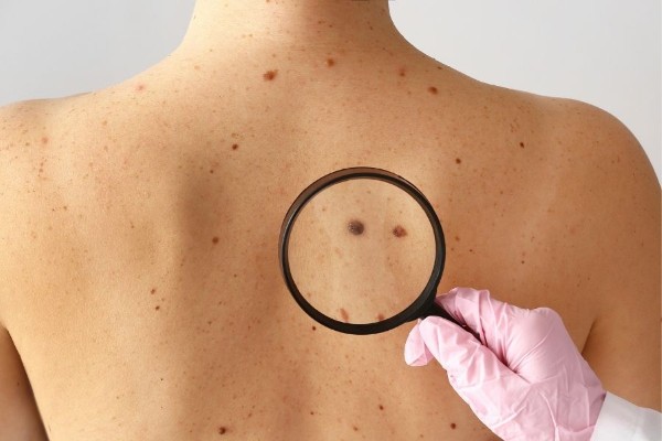 Tẩy nốt ruồi to và lồi có an toàn không?