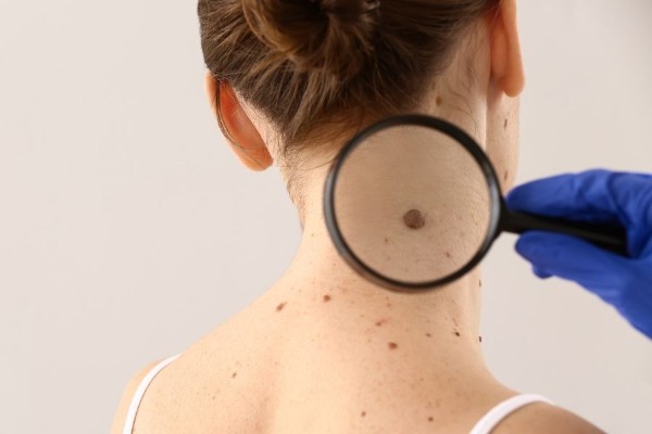 Dấu hiệu nhận biết nốt ruồi lành tính và ác tính