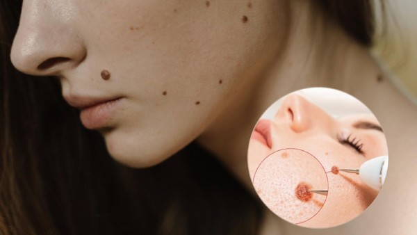 Laser – Phương pháp tẩy nốt ruồi to và lồi hiệu quả nhất