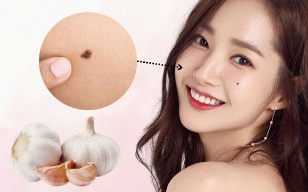 Cách tẩy nốt ruồi lồi tại nhà bằng mẹo dân gian