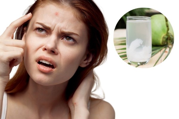 Uống nước dừa có nổi mụn không?