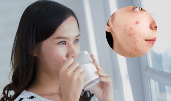 [Giải đáp chi tiết] Uống sữa có nổi mụn không?
