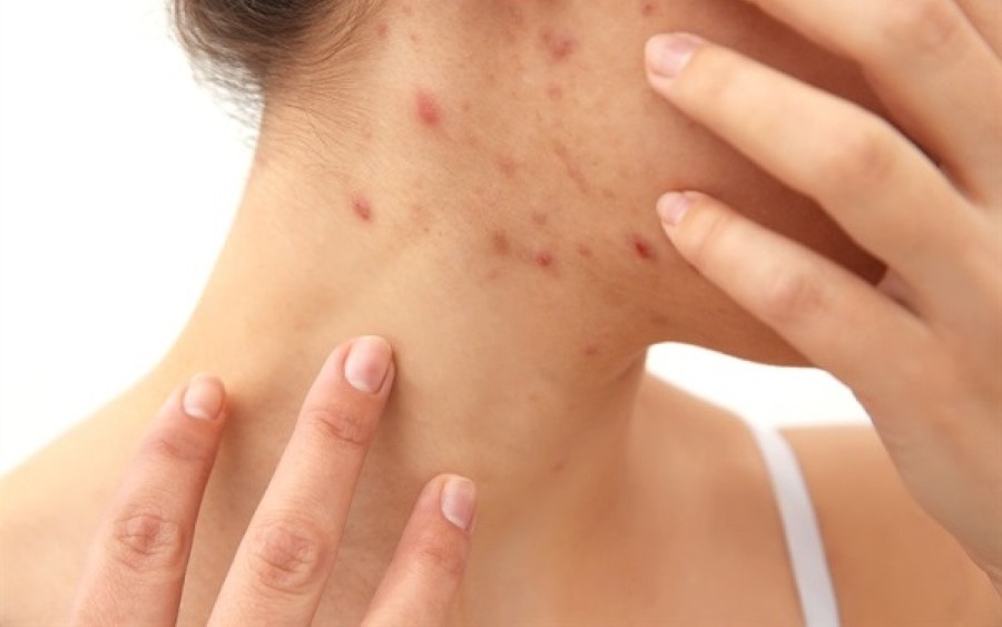 Ăn hạt hướng dương có nổi mụn không?