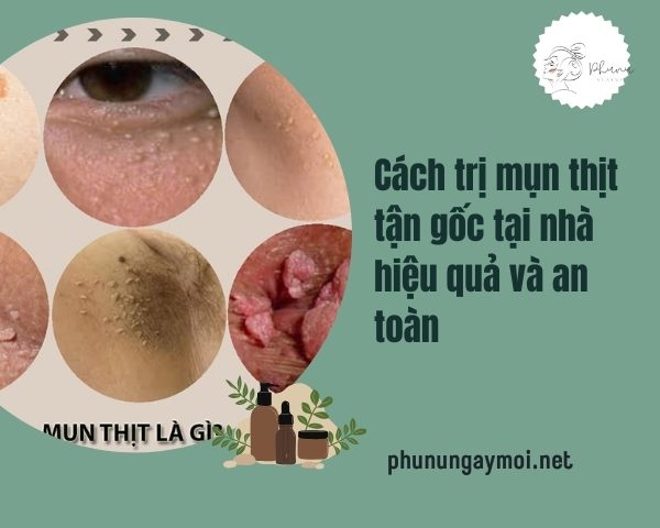 Cách trị mụn thịt