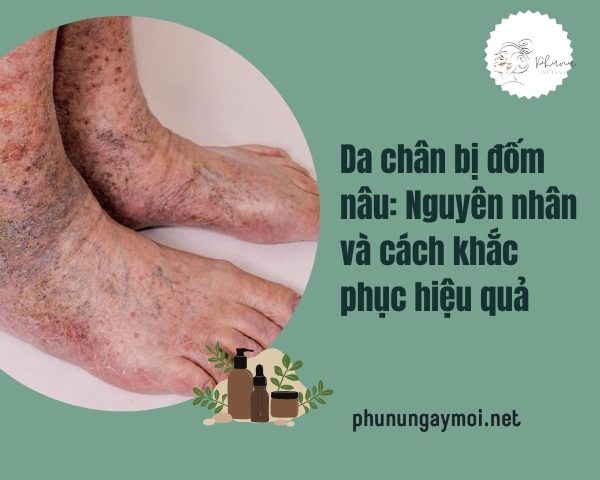da chân bị đốm nâu