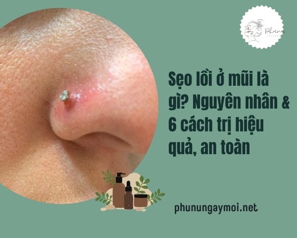 Sẹo lồi ở mũi