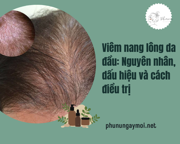viêm nang lông da đầu