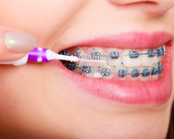 Nên chăm sóc răng niềng đúng cách