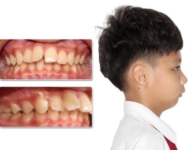 cằm lẹm niềng răng