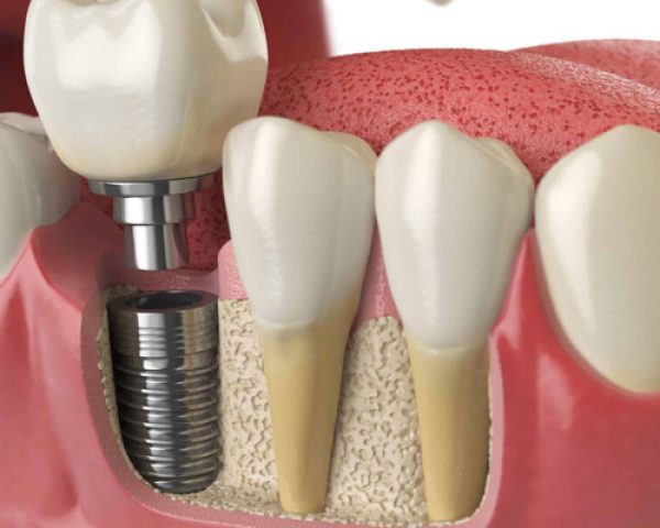 Cấy Ghép Implant: Giải Pháp Hoàn Hảo Cho Hàm Răng Của Bạn