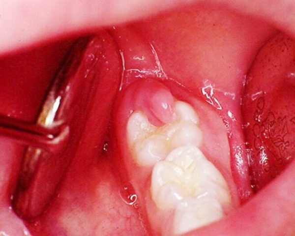 loi-trum-len-rang-khon-1