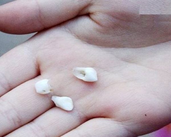 Mỗi quốc gia có quan niệm về giấc mơ rụng răng khác nhau